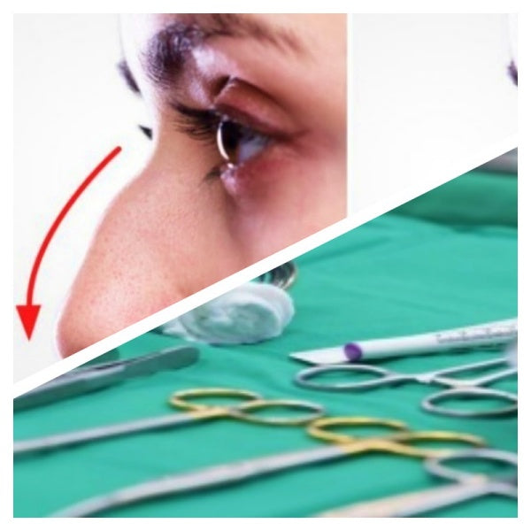 Rhinoplasty Surgery Instruments Set