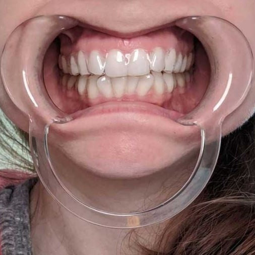 Cheek Retractor C-Shaped